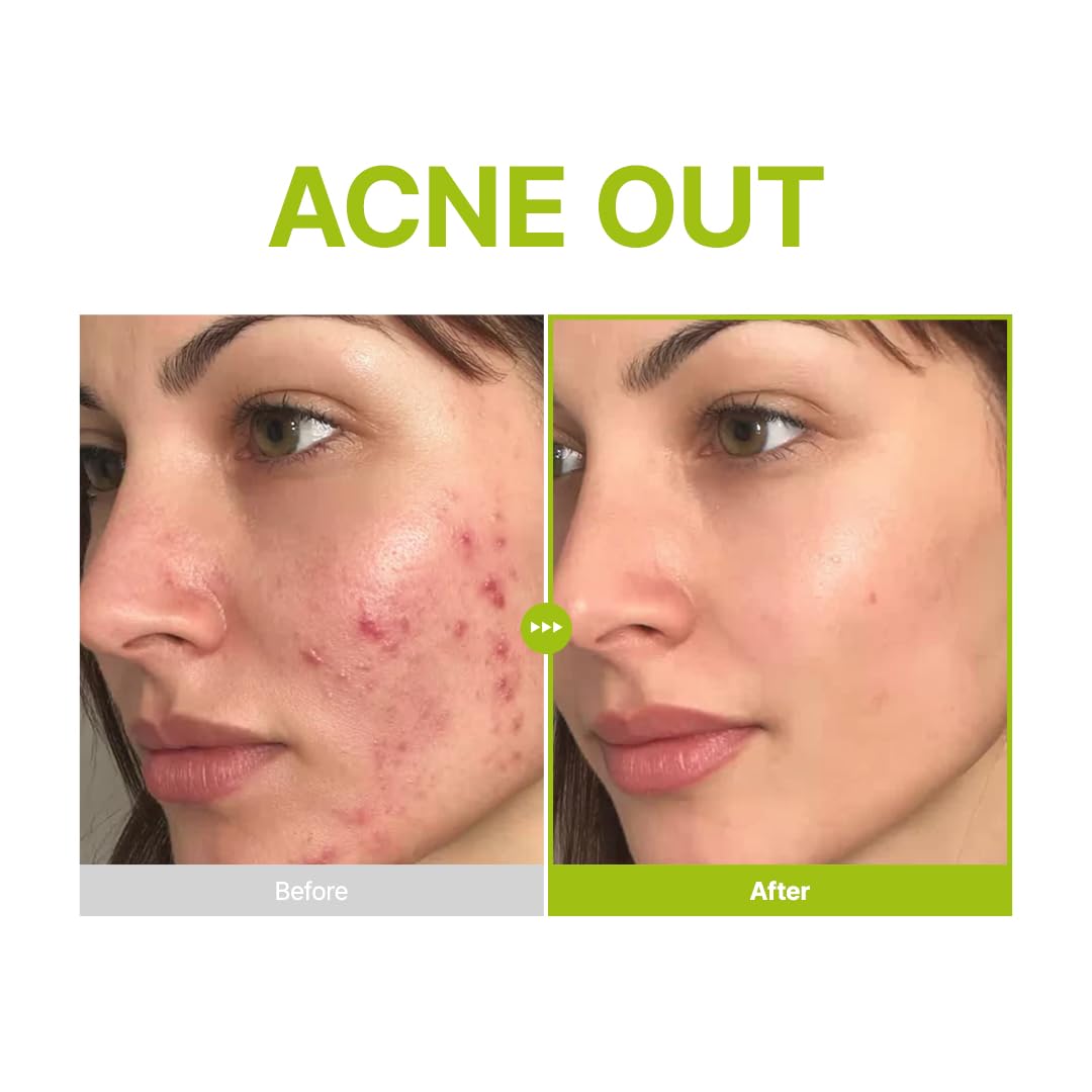 Azelaic Acid 10 Kojic Tea Tree Serum