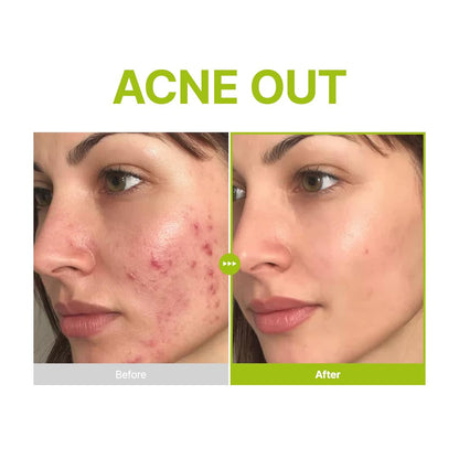 Azelaic Acid 10 Kojic Tea Tree Serum