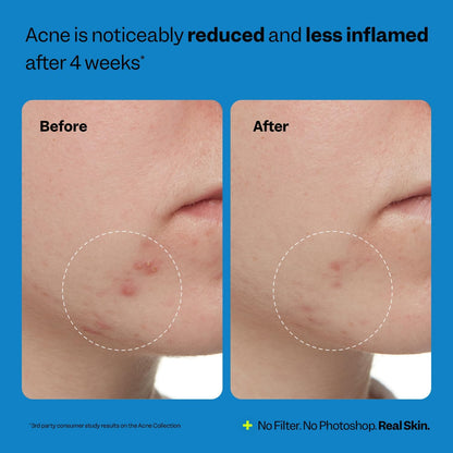 Acne Exfoliating Toner