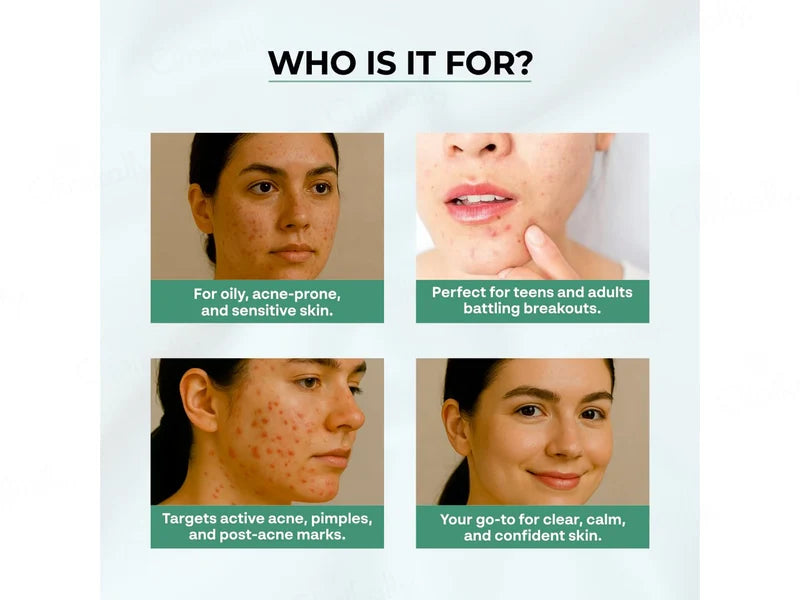 Dr. Sakhiya’s Acne & Pimple Moisturizer – Soin Hydratant Anti-Acné