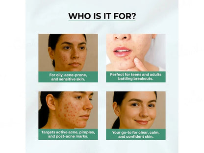 Dr. Sakhiya’s Acne & Pimple Moisturizer – Soin Hydratant Anti-Acné