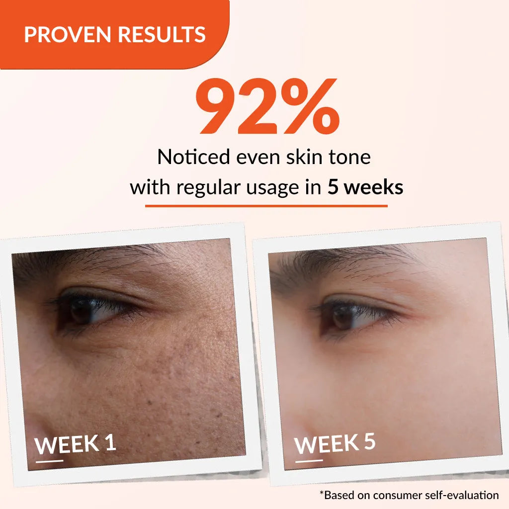Skarfix-TX Cream | Effective treatment for melasma and dark spots